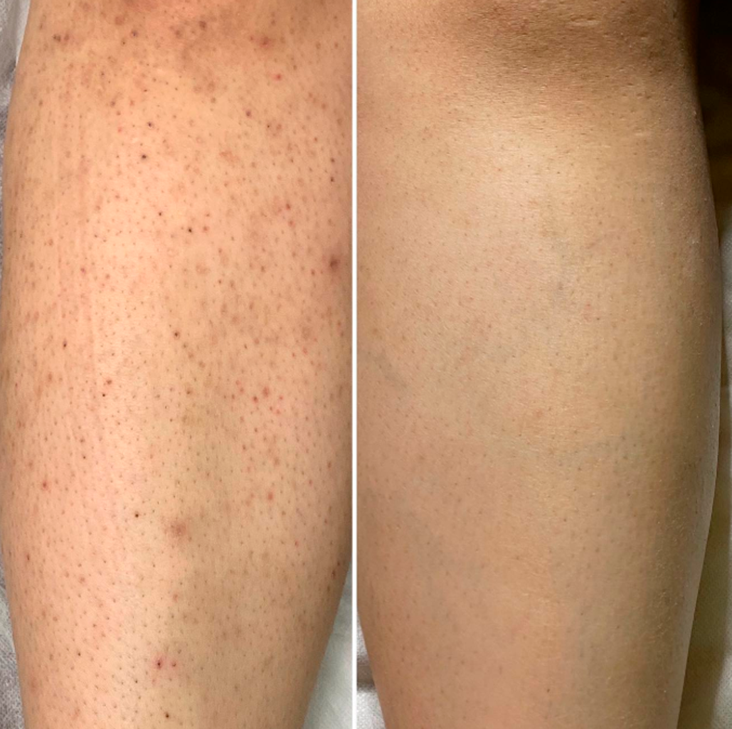 Cyperus Rotundus Oil For Hair Removal